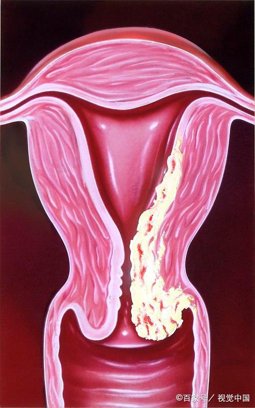 子宫腺肌症不必切子宫，这项保宫手术已改变上万女性命运